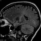MRI de una persona con esclerosis lateral amiotrófica. Wikimedia Commons